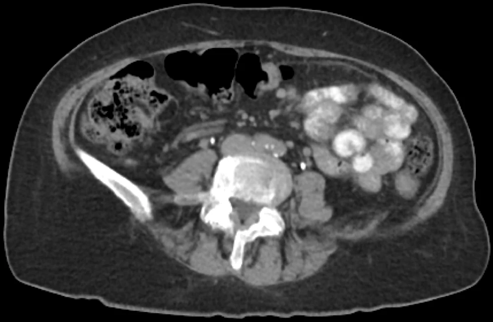 Axial slice of the same CT — a cross-section through the
                      abdomen at the level of the spine.