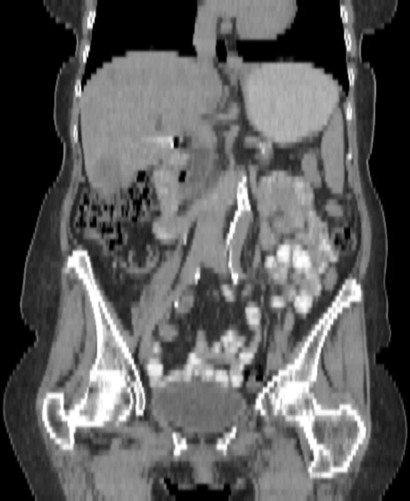 Coronal reconstruction of a chest-abdomen-pelvis CT — a
                      front-on slice through the body showing liver, bowel and
                      the pelvic bones.