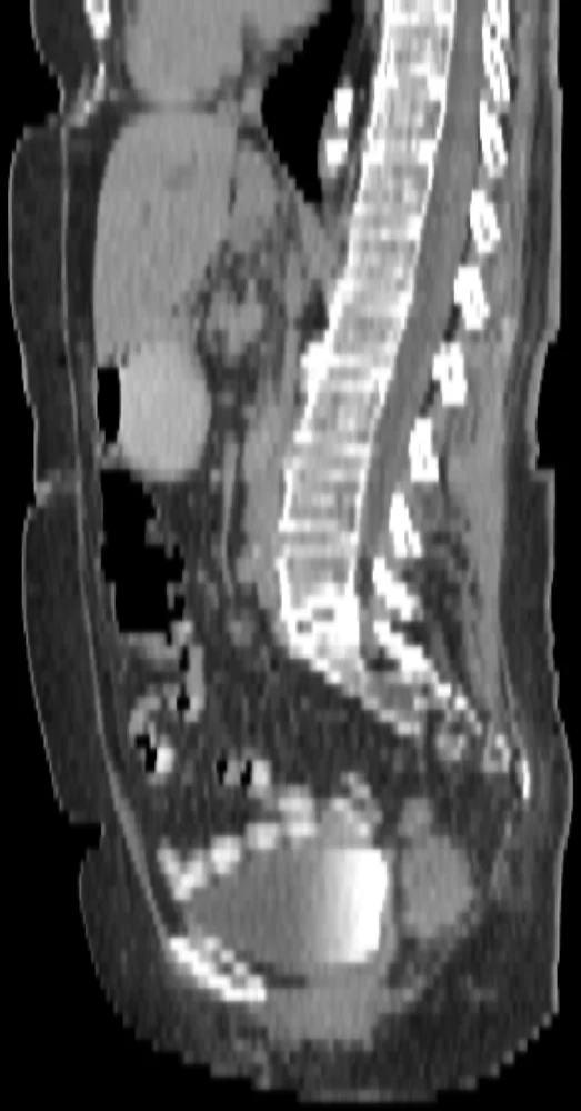 Sagittal reconstruction of the same CT — a side-on slice
                      showing the spine in profile.